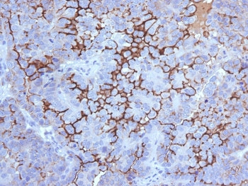 IHC testing of FFPE human ovarian carcinoma with MUC16 antibody (clone 5E11). Required HIER: steam s