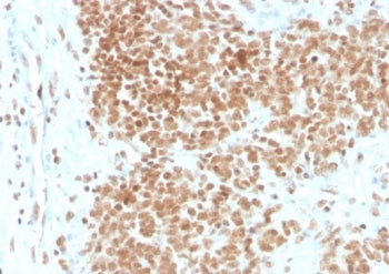 IHC staining of FFPE human Ewing's Sarcoma (EWS) with FLI1 antibody (clone FLI1/4371R). HIER: boil t