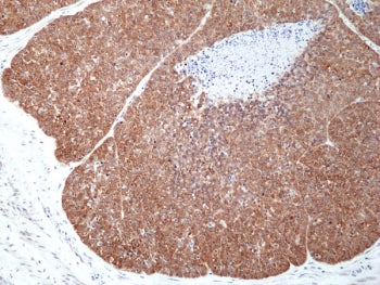 IHC staining of FFPE human esophageal squamous carcinoma tissue with recombinant MSI2 antibody at 1: