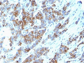 IHC: Formalin-fixed, paraffin-embedded human breast carcinoma stained with Mucin-1 antibody (clone S