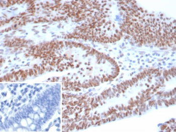 IHC staining of FFPE human ovarian carcinoma tissue with p53 antibody (clone TP53/8183R). Inset: PBS