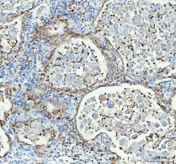 IHC testing of FFPE human lung cancer tissue with AQP4 antibody. HIER: Boil the paraffin sections in