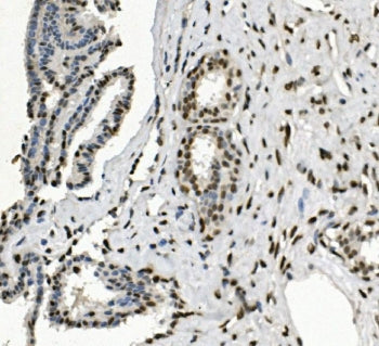 IHC staining of FFPE human breast cancer with HP1 alpha antibody. HIER: boil tissue sections in pH8 