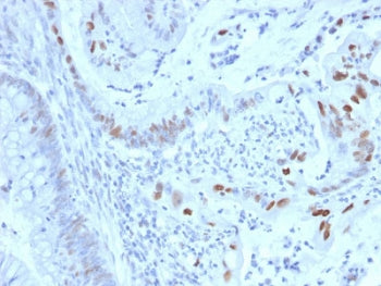 IHC staining of FFPE human colon carcinoma with with Cyclin E1 antibody (clone CCNE1/2460). HIER: bo