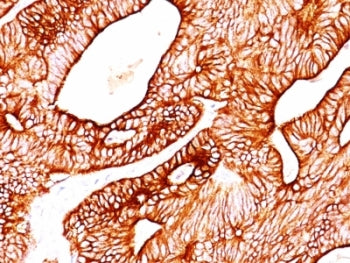 IHC: Formalin-fixed, paraffin-embedded human colon carcinoma stained with Cytokeratin 5/8 antibody (