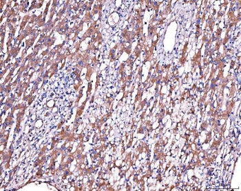 IHC staining of FFPE human liver cancer tissue with SERPINF2 antibody. HIER: boil tissue sections in