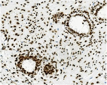 IHC staining of FFPE human breast cancer with TRIM28 antibody. HIER: boil tissue sections in pH8 EDT
