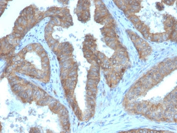 IHC staining of FFPE human prostate carcinoma with CD47 antibody (clone CD47/3019). HIER: boil tissu