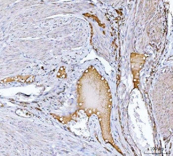 IHC staining of FFPE human endometrial cancer tissue with Clusterin antibody. HIER: boil tissue sections in pH8 EDTA for 20 min and allow to cool before testing.