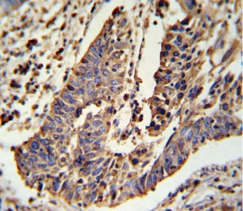 IHC testing of FFPE human lung carcinoma tissue with SCNN1A antibody. HIER: steam section in pH6 cit