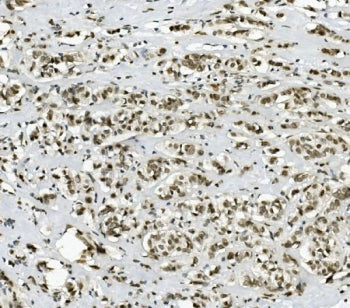 IHC staining of FFPE human breast cancer with PRDM5 antibody. HIER: boil tissue sections in pH8 EDTA