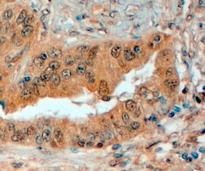 IHC testing of FFPE human prostate with Semaphorin 3E antibody at 4ug/ml. HIER: steamed with pH6 cit
