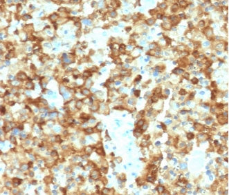 IHC testing of human melanoma with Melanoma gp100 antibody (clone MSSG95-2). Required HIER: boil tis