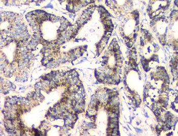 IHC staining of FFPE human intestinal cancer with FH antibody. HIER: boil tissue sections in pH8 EDT