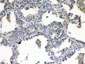 IHC testing of FFPE human lung cancer tissue with TIMP4 antibody at 1ug/ml. Required HIER: steam sec