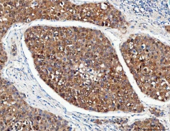 IHC staining of FFPE human liver cancer tissue with PSMD14 antibody. HIER: boil tissue sections in p