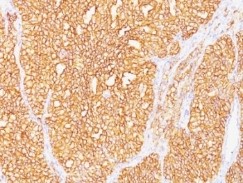 IHC: Formalin-fixed, paraffin-embedded human renal cell carcinoma stained with Carbonic Anhydrase IX
