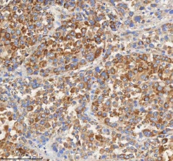 IHC staining of FFPE human liver cancer tissue with PCCA antibody. HIER: boil tissue sections in pH8
