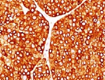 IHC testing of FFPE human melanoma with Tyrosinase antibody (clone TRSN1-1). Staining of formalin-fi