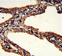 IHC testing of FFPE human prostate carcinoma tissue with PSMB9 antibody. HIER: steam section in pH6 