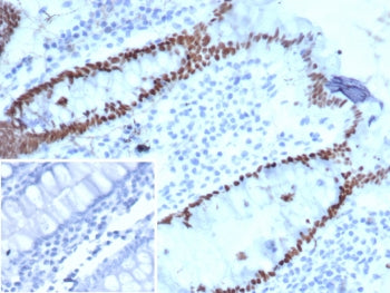 IHC staining of FFPE human colon carcinoma tissue with SATB2 antibody. Strong nuclear staining is ob