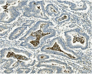 IHC staining of FFPE human rectal cancer with ATG4A antibody. HIER: boil tissue sections in pH8 EDTA