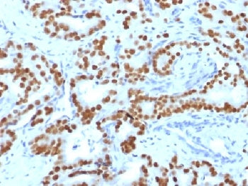 IHC testing of FFPE human prostate carcinoma with FOXA1 antibody (clone FOXA1/1519). HIER: boil sect