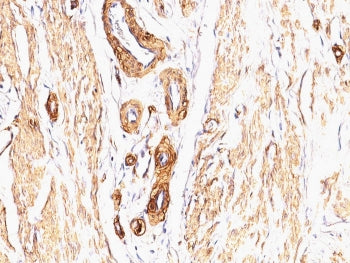 IHC: Formalin-fixed, paraffin-embedded Leiomyosarcoma stained with Smooth Muscle Actin antibody (clo