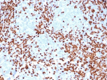 IHC staining of FFPE human thymus tissue with DNTT antibody (clone rDNTT/6909). HIER: boil tissue se
