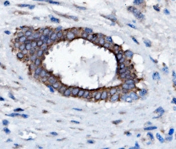 IHC staining of FFPE human breast cancer with SLC25A1 antibody. HIER: boil tissue sections in pH8 ED