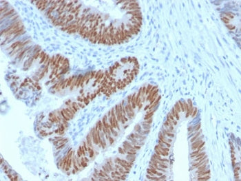 IHC testing of FFPE human colon carcinoma with recombinant CDX2 antibody (clone CDX2/2951R). HIER: b