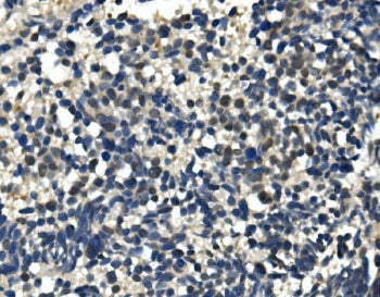 IHC staining of FFPE human lung cancer with ULK1 antibody. HIER: boil tissue sections in pH8 EDTA fo