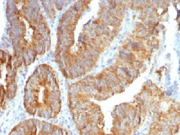 IHC testing of FFPE human colon carcinoma with TL1A antibody (clone VEGI/1283). Required HIER: boil 