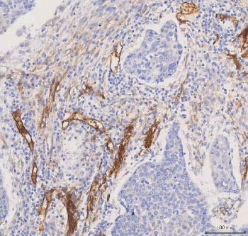 IHC staining of FFPE human bladder urothelial carcinoma tissue with Aquaporin 1 antibody. HIER: boil
