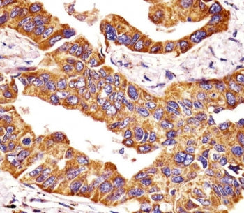 IHC testing of FFPE human lung adenocarcinoma tissue with MMP14 antibody. HIER: steam section in pH6