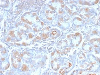 IHC staining of FFPE human stomach carcinoma with recombinant pS2 antibody (clone TFF1/2969R). HIER: