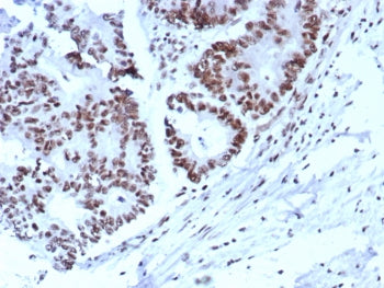 IHC staining of FFPE human colon. Strong nuclear staining using KIP2/8572 at 2ug/ml. HIER: boil tiss
