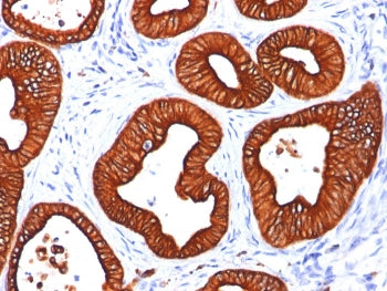 IHC: Formalin-fixed, paraffin-embedded human colon carcinoma stained with Cytokeratin 18 antibody (c