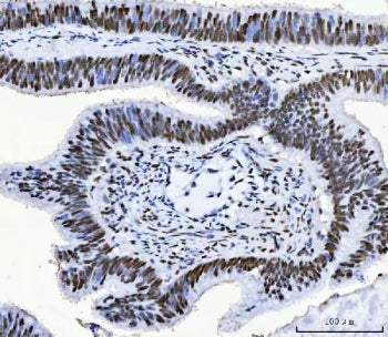 IHC staining of FFPE human colorectal adenocarcinoma tissue with CFIm68 antibody. HIER: boil tissue 