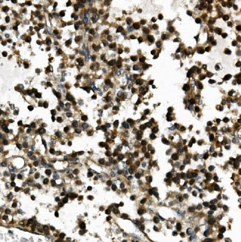 IHC staining of FFPE human testis cancer with USP44 antibody. HIER: boil tissue sections in pH8 EDTA