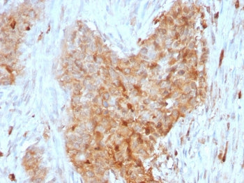 IHC staining of FFPE human breast carcinoma with Glucose 6-Phosphate Isomerase antibody (clone CPTC-