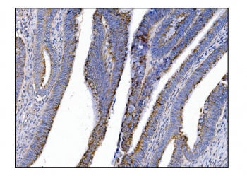 IHC staining of FFPE human rectal cancer tissue with MerTK antibody. HIER: boil tissue sections in p