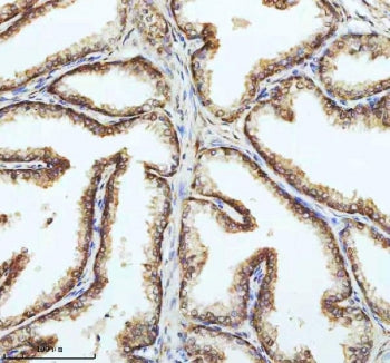 IHC staining of FFPE human prostate cancer tissue with PIN4 antibody. HIER: boil tissue sections in 