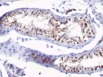 IHC: Formalin-fixed, paraffin-embedded human testicular carcinoma stained with anti-Thymidylate Synt