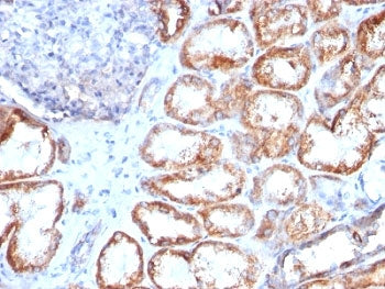 IHC: Formalin-fixed, paraffin-embedded human renal cell carcinoma stained with HSP60 antibody (clone