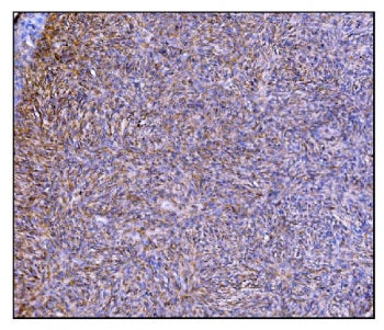 IHC staining of FFPE human skin cancer tissue with Prolyl Endopeptidase antibody. HIER: boil tissue 