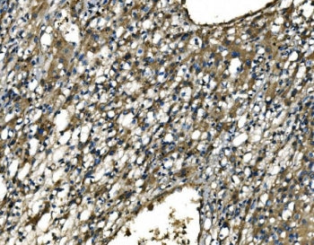 IHC staining of FFPE human liver cancer tissue with CMKBRL1 antibody. HIER: boil tissue sections in 