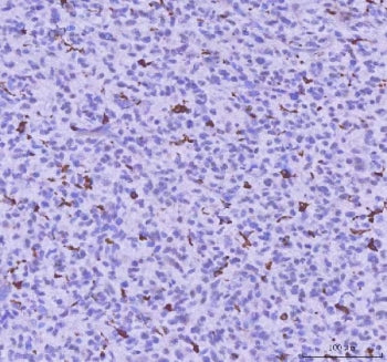 IHC staining of FFPE human glioma tissue with LPCAT2 antibody. HIER: boil tissue sections in pH8 EDT