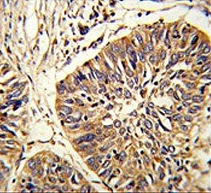 IHC testing of FFPE human lung carcinoma tissue with Protein disulfide-isomerase A3 antibody. HIER: 