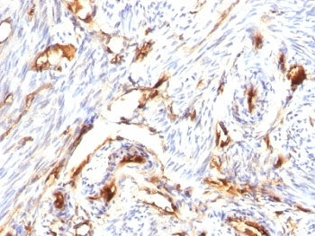 IHC: Formalin-fixed, paraffin-embedded human endometrial carcinoma stained with Beta-2-Microglobulin